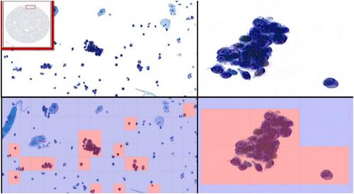 Computer-assisted urine cytology: Faster, cheaper, better?