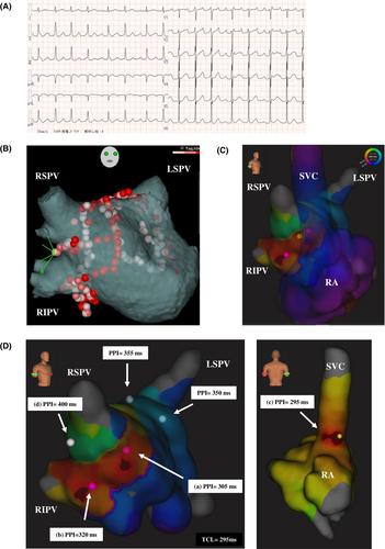 A case of biatrial tachycardia involving the intercaval bundle with assumed dual loop reentry