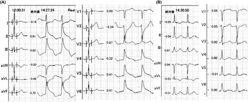 Atropine sulfate may be effective to recover the unstable hemodynamics in coronary artery spasms related to atrial fibrillation ablation procedures