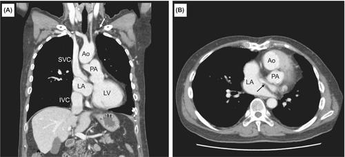 Helix-fixation leadless pacemaker as a potential alternative to conventional transvenous pacemaker in post-Mustard baffle stenosis