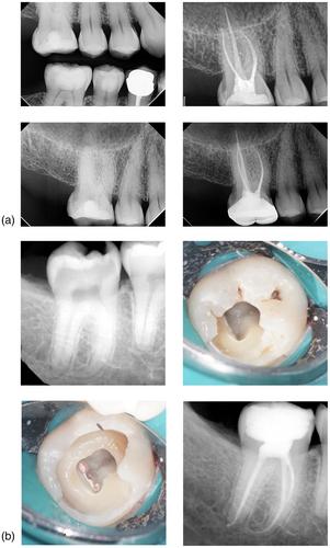 Guidelines for non-surgical root canal treatment