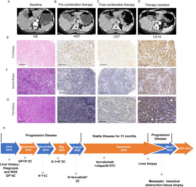 PARP inhibitor and immune checkpoint inhibitor have synergism efficacy in gallbladder cancer