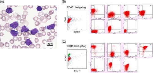 Effective treatment of relapsed/refractory CD19-positive B/T-type mixed-phenotype acute leukemia with blinatumomab: A case report