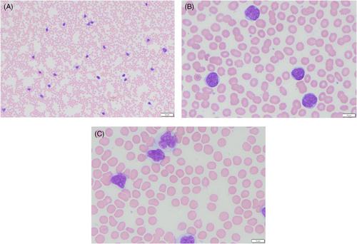 CD4+ chronic lymphocytic leukemia in an 86-year-old male veteran: A case report