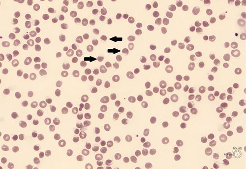 Acquired glucose-6-phosphate dehydrogenase deficiency after allogeneic stem-cell transplantation