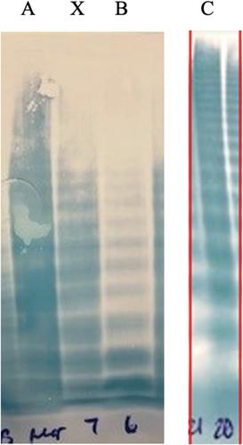 Intravenous Immunoglobulin offers temporary improvement in acquired von Willebrand syndrome due to monoclonal gammopathy: A case report