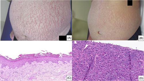 Asteatotic eczema, a cutaneous manifestation of Hodgkin lymphoma in older patients