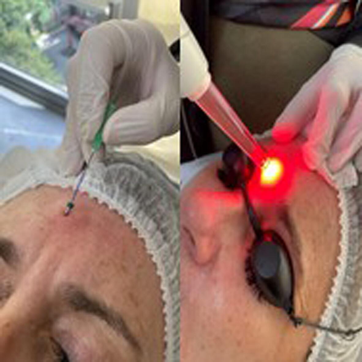 Combining red photobiomodulation therapy with polydioxanone threads for wrinkle reduction in the glabella region: A randomized, controlled, double-blind clinical trial