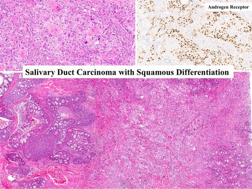 Salivary duct carcinoma with squamous differentiation: histomorphological and immunophenotypical analysis of six cases