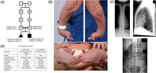 Bi-allelic variants in MYH3 cause recessively-inherited arthrogryposis