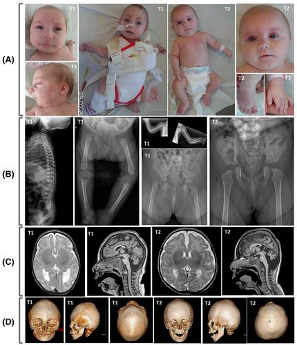 B-cell immune deficiency in twin sisters expands the phenotype of MOPDI