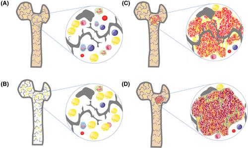 Bone marrow necrosis: Facts, controversies, and perspective