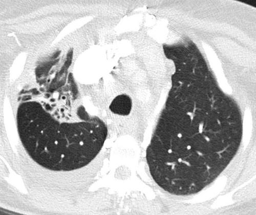 Chest computed tomography findings among adult Aboriginal Australians with bronchiectasis in the Top End Northern Territory of Australia