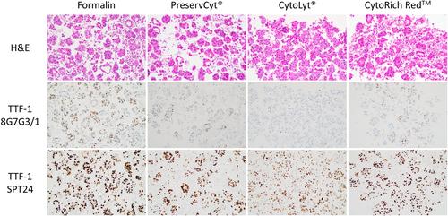 The impact of different fixatives on immunostaining of lung adenocarcinomas in pleural effusion cell blocks