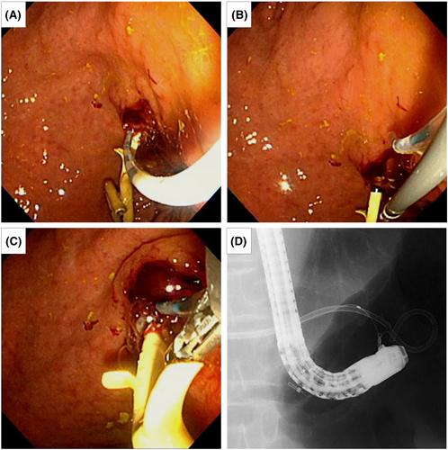 Effective use of the two-devices-in-one-channel technique for stent exchange following endoscopic ultrasound-guided hepaticogastrostomy