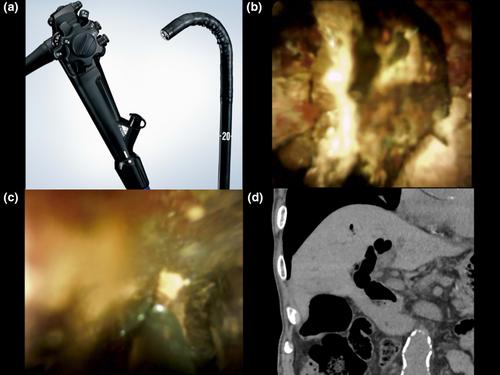 A case of complete removal of stacked common bile duct stones by peroral direct digital cholangioscopy in a patient with surgically altered anatomy