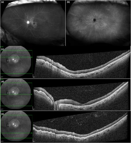 A possible association between intraocular pressure changes and pigment epithelial detachment in central serous chorioretinopathy