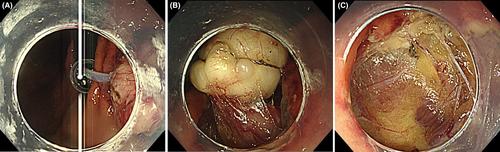 Advancements in minimally invasive endoscopic treatment: Navigating deeper layers for upper gastrointestinal lesion