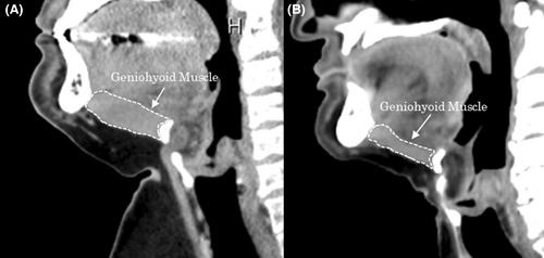 Preoperative geniohyoid muscle mass in esophageal cancer patients is associated with swallowing function after esophagectomy