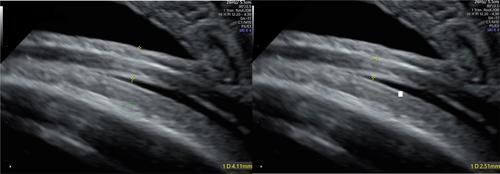 Accuracy of sonographic lower segment thickness and prediction of vaginal birth after caesarean in a resourced-limited setting; Prospective study