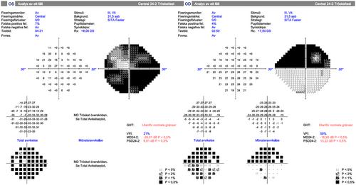 Occult GCA: A rare variant of Giant Cell Arteritis