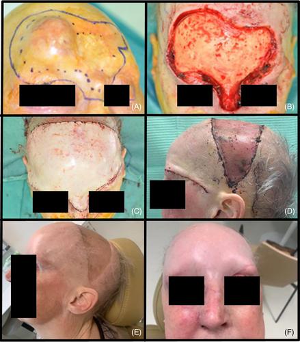 Visor flap: A solution for the reconstruction of large skin defects on the frontal and parietal parts of the skull.