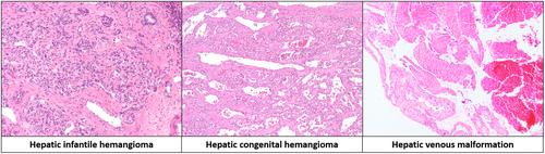 Diagnostic approach to hepatic vascular lesions: a paediatric perspective