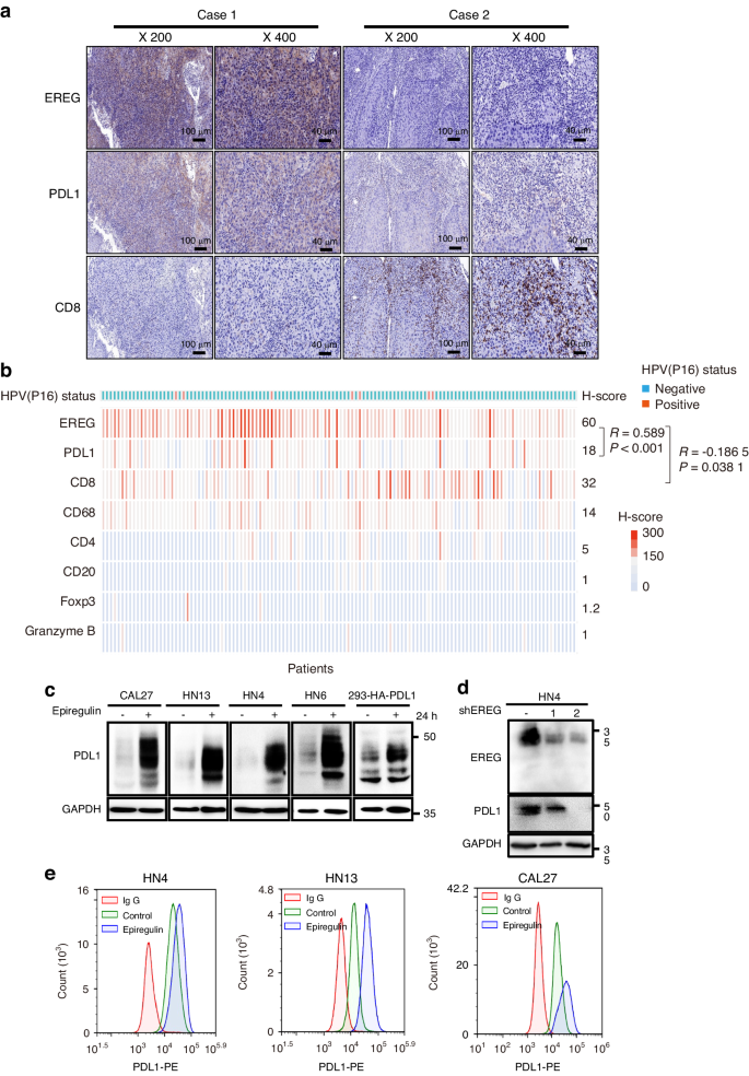 Stabilization of EREG via STT3B-mediated N-glycosylation is critical for PDL1 upregulation and immune evasion in head and neck squamous cell carcinoma.