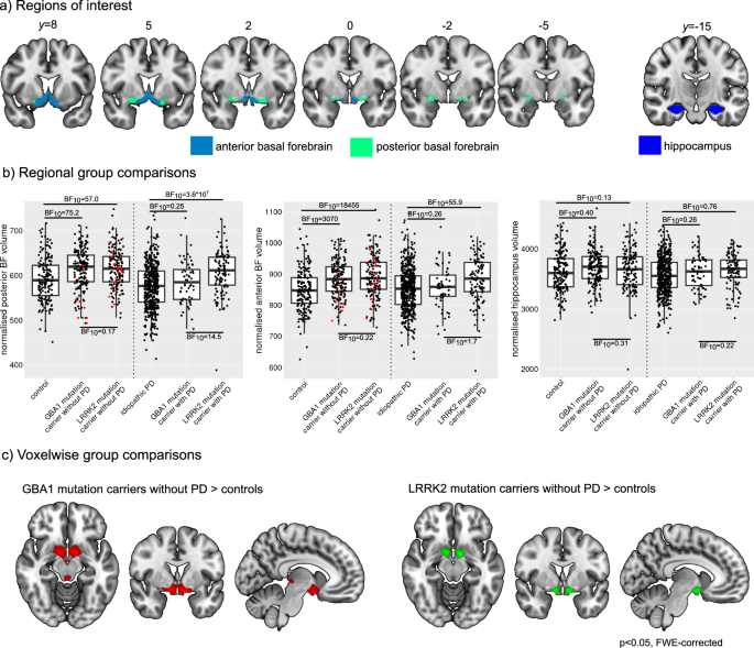 Associations of cholinergic system integrity with cognitive decline in GBA1 and LRRK2 mutation carriers.