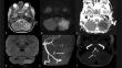 Isolated cerebellar stroke in a paediatric patient with typical haemolytic uraemic syndrome: a case report and literature review.