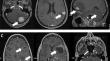 Defining the role of surgery for patients with multiple brain metastases.