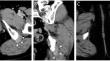 Sustained Effectiveness of Transcatheter Arterial Microembolization for Refractory Ischiogluteal Bursitis.