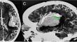 Microsurgical management of a ruptured intracranial mycotic aneurysm in infancy.