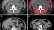 Myosteatosis in multiple myeloma: a key determinant of survival beyond sarcopenia.