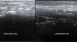 Ultrasound as a Diagnostic Modality in Hand and Wrist Musculoskeletal Pathologies: A Narrative Review