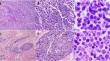 Transdifferentiation of diffuse large B-cell lymphoma to a poorly differentiated neoplasm following CAR T-cell therapy.