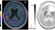 Amino-acid PET as a prognostic tool after post Stupp protocol temozolomide therapy in high-grade glioma patients.