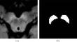 Preliminary study of substantia nigra analysis by tensorial feature extraction.