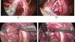 Comparison of proximal and distal laparoscopic ureteroureterostomy for complete duplex kidneys in children.