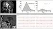 Post-surgical spontaneous paroxysmal hypothermia: a case series.