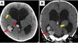 Neonatal intracranial haemorrhage secondary to vein of Galen aneurysmal dilatation.