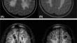 Vanishing white matter disease: imaging, clinical and molecular correlation in Brazilian families.