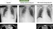 Clinical Issue of Myasthenia Gravis Related to Immune Checkpoint Inhibitors.