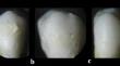 Performance of two laser motion modes versus conventional orthodontic ceramic brackets debonding technique on enamel surface topography.