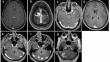 Intracranial angioleiomyoma: a case series of seven patients and review of the literature.