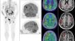 Extramedullary disease in multiple myeloma: what you might not expect on [18F]FDG PET/CT - a pictorial essay