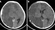 Decompressive craniectomy in children: indications and outcome from a tertiary centre.