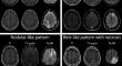 Prognostic significance of MRI contrast enhancement in newly diagnosed glioblastoma, IDH-wildtype according to WHO 2021 classification.