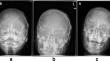 Torticollis as a rare, late complication of VP shunt placement in the pediatric population: a case report.