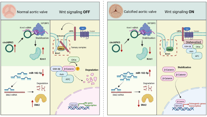 Noncoding RNA regulates the expression of Krm1 and Dkk2 to synergistically affect aortic valve lesions